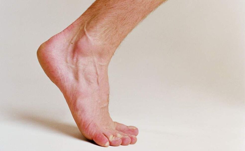 pėdų grybelio simptomai