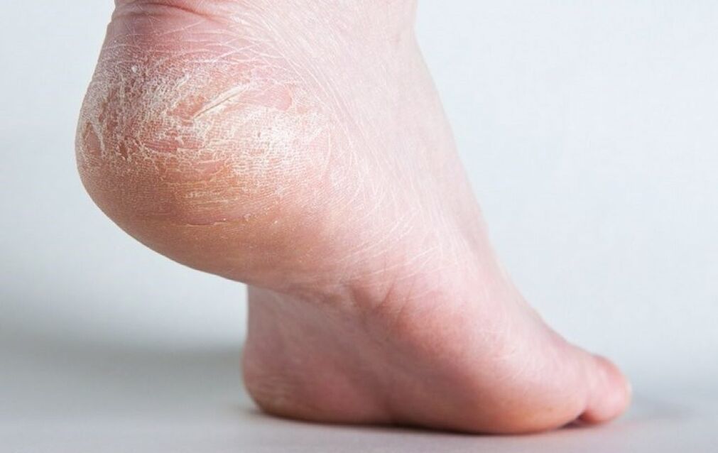 grybelis ant kojų odos