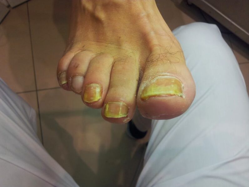 geltoni kojų nagai su grybeliu