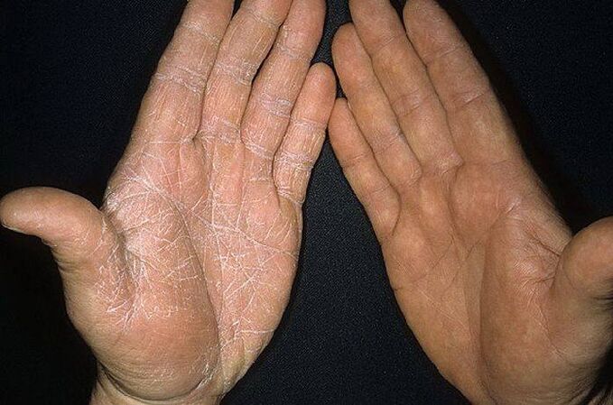 grybelio simptomai ant rankų odos