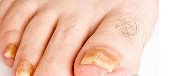 kojų nagų grybelio veislės