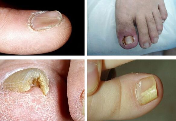 Kojų onichomikozės simptomai